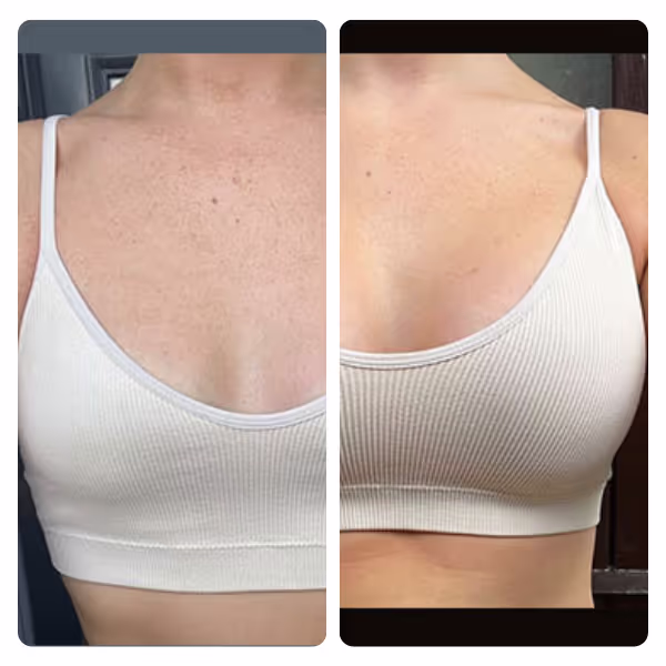 Breast Reduction in Turkey